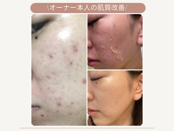エスラボ オオサカ 心斎橋/【オーナー本人の肌質改善】