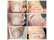 リベロネイル(Libero Nail)の雰囲気（韓国で特許を取得した特別な方法で巻き爪ケア◎）