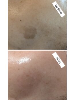 イロドリ(irodori)/シミ改善!104日間プログラム♪