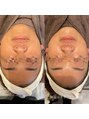 エクラ(eclat)&nbsp;顔セルで二重あご解消！フェイスラインもしっかり出ます♪