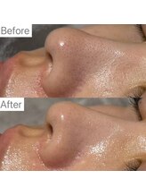 ホワイトラボ 姫路(White labo)/【施術例】ハイドロフェイシャル