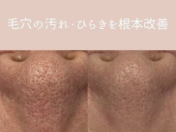 ベアール(beal)の写真/【毛穴悩みに本気の集中ケア】毛穴状態に合わせた２種のハーブピーリング!剥離ありor毛穴洗浄+剥離なし