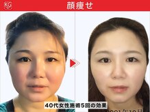 那賀洋子式 顔ジム 大分戸次店/40代女性顔ジム継続の効果