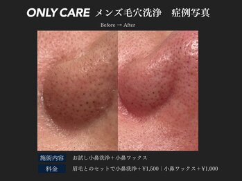 オンリィケア 近大前(ONLY CARE)/【メンズ毛穴洗浄】