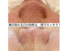 プランス 福岡(PLANCE)/毛穴の角栓／福岡天神エステ