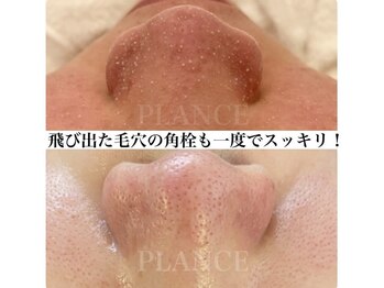 プランス 福岡(PLANCE)/毛穴の角栓／福岡天神エステ