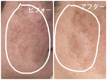 ノーブル シャット Noble Chate/ほほ全体!浮き出たようなシミが