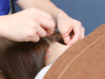 越谷ヘルム鍼灸整体院(越谷HELM鍼灸整体院)/鍼施術も可能です☆