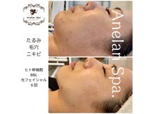 アネランスパ(Anelan Spa.)