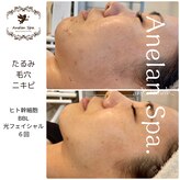 アネランスパ(Anelan Spa.)