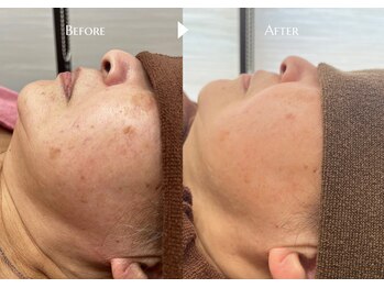 シャイニー/光フェイシャル13回