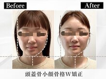 ポーベルポー(Peau Belle poe)/究極の頭蓋骨小顔W矯正で美人顔