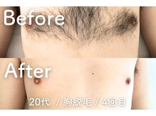 ユング 渋谷店(YUNG)/【胸脱毛】堂々と脱げるあなたへ