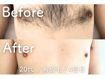 ユング 渋谷店(YUNG)/【胸脱毛】堂々と脱げるあなたへ