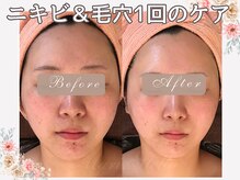 マリスステラ 天王寺(MarisStella)/小顔＆ニキビケア1回目