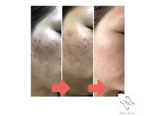 サロンフロム つくば店(Salon From)/◆Ravissaフェイシャル◆