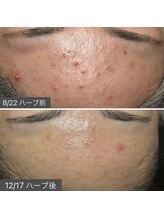 ロッタ エクリュ(Lotta ecru+)/REVI剥けないハーブピーリング