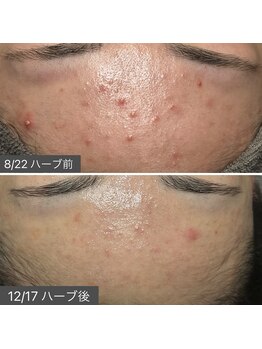 ロッタ エクリュ(Lotta ecru+)/REVI剥けないハーブピーリング