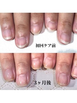 ネイルサロン アミュゼの写真/3カ月集中の自爪育成☆「美爪育ネイルケアコース」ネイリストと二人三脚で取り組み縦長の美爪に♪