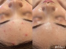 エヌエースキン 北谷店(NAskin)/ハーブピーリング｜ニキビケア