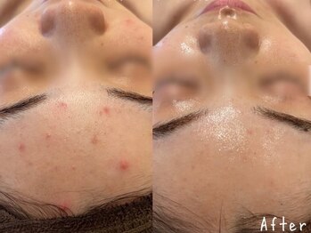 エヌエースキン 北谷店(NAskin)/ハーブピーリング｜ニキビケア