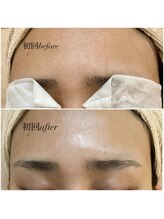 リコア(Likoa)/初回のbefore afterです