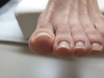 ミンスネイル(Mins Nail)の写真/フットネイル☆巻き爪矯正◎痛みが少ない！目立たない！[ヘイスイッチ] 巻き爪専用ジェルで改善！