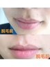 脱毛　お好きな箇所3部位
