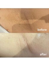 ラブ美長寿 沖縄本店(Lab)/【ビフォーアフター】ワキ脱毛