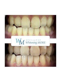 ホワイトニング モア(Whitening MORE)/ビフォーアフター