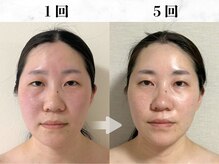 5回で人から「なんかしてる？」と聞かれるように♪【小顔】