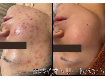 ダリアの写真/天然由来成分100%、酸性0%☆美容業界最高峰2Bハーブピーリングで肌育!!敏感肌の方にもおススメです◎