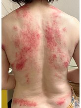 ビレイ(Birei)/カッサ＋カッピング