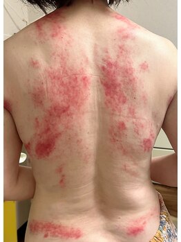 ビレイ(Birei)/カッサ＋カッピング