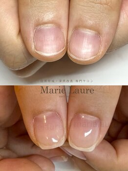 マリーロール 梅田店(Marie Laure)/深爪矯正/自爪育成/自爪風
