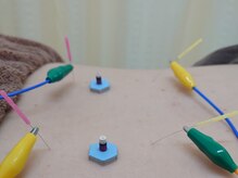 みてら鍼灸整骨院/電気鍼と灸施術