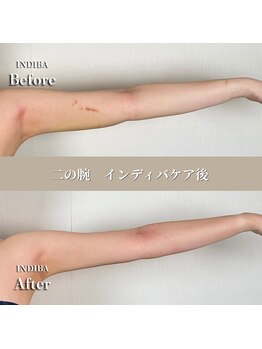 術後の女神 大阪心斎橋店/術後ケアインディバ・インディバ