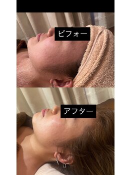 アカヒゲ(AKAHIGE)/ピーリング