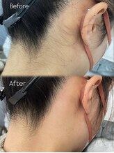 サロンドベルム(Salon de BELME)/ダブル脱毛：before/after