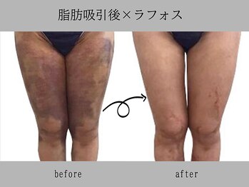 プレリー 自由が丘店/術後ケア　ラフォス