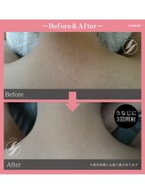 ルル(LULU.)/うなじ脱毛