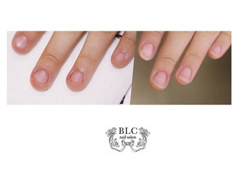 ビーエルシー ネイルサロン(BLC nail salon)/コンプレックス爪