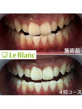 ルブラン 奈良店(Le Blanc)/【4回コースございます】