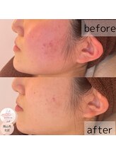 アンテイン チル(anthein chill)/陶肌トリートメント