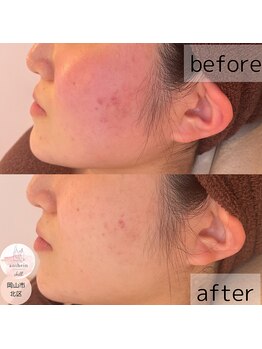 アンテイン チル(anthein chill)/陶肌トリートメント