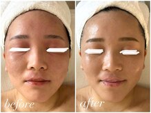 フォー(For...)/肌改善・肌荒れ◇クリスティーナ