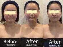 小顔フェイスラボ 四日市店(小顔FaceLabo.)/◆小顔コルギ Before→After◆
