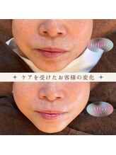 ナオフクオカ ヒーリングフォースエヌ(NaoFukuoka/healingforceN)/リセルシュールで艶肌MAX！