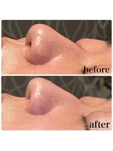 ディオーネ 春日井勝川店(Dione)/顔脱毛＋毛穴洗浄