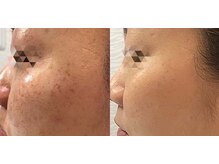 アティロン(Attirant)/【パーツごとに徹底シミ改善】